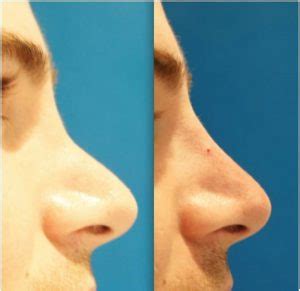 Nose Filler Non Surgical Rhinoplasty At Our Expert Sydney Clinic