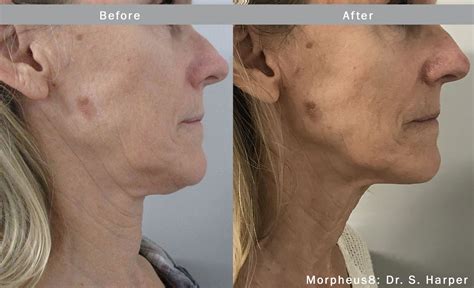 Morpheus8 Skin Tightening In Luton Skin House Luton