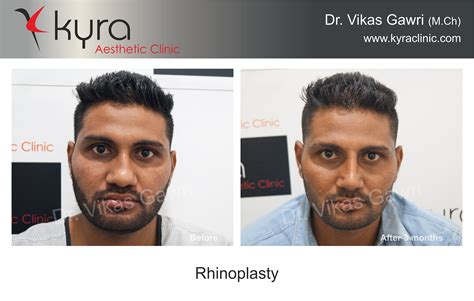 Best Nose Job - Cosmetic Surgery in Ludhiana