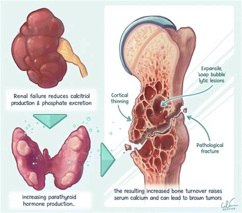 Osteitis Fibrosa List Of Disease Hot Sex Picture