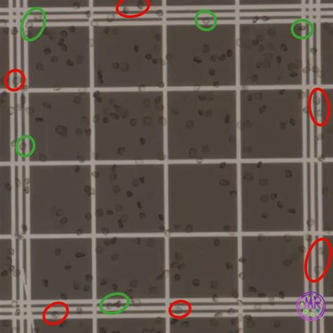 Recuento De Eritrocitos En Hemocit Metro El Laboratorio De Marrodmir