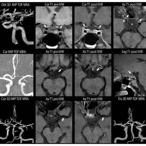 Reversible Cerebral Vasoconstriction Syndrome With Associated Download Scientific Diagram