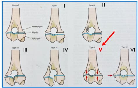 Approach To Fractures Flashcards Quizlet