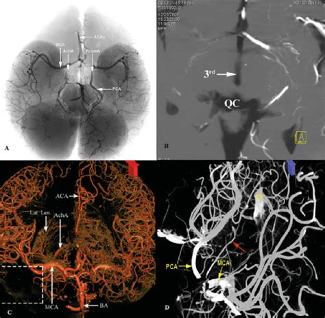 A Fluoroscopic Inferior Superior View Of A Cadaveric Brain Perfused