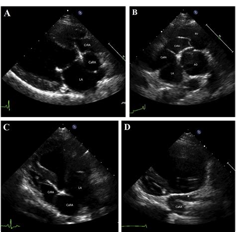 Figure 1 From Stent Placement For Palliation Of Cor Triatriatum Dexter