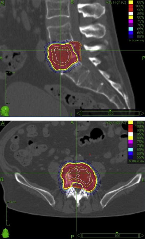 Stereotactic Body Radiotherapy For Spinal And Bone Metastases