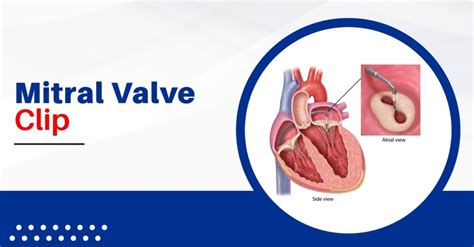 Mitral Valve Clip | Procedure and Recovery | Dr Mayur Jain