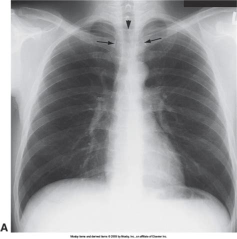 Chest Radiographs Flashcards Quizlet