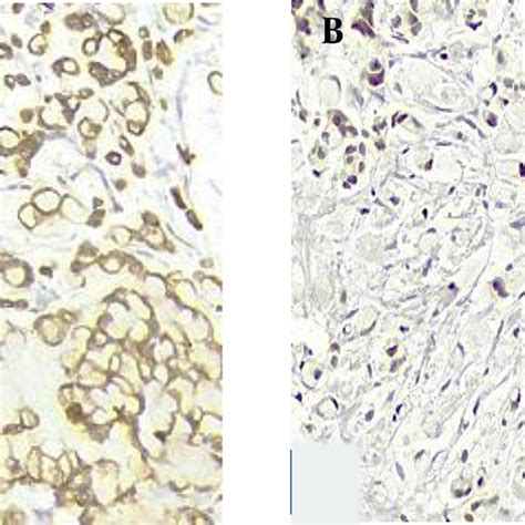 A Strong Diffuse Membranous Immunostaining With Ck Ihc X B