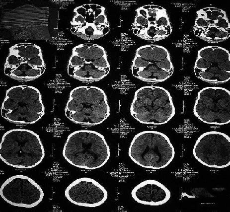 CT Scan of the Patient Showing Enlarged Fourth Ventricle and Separated... | Download Scientific ...