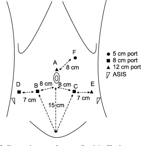 Figure 1 From Robot Assisted Laparoscopic Radical Prostatectomy