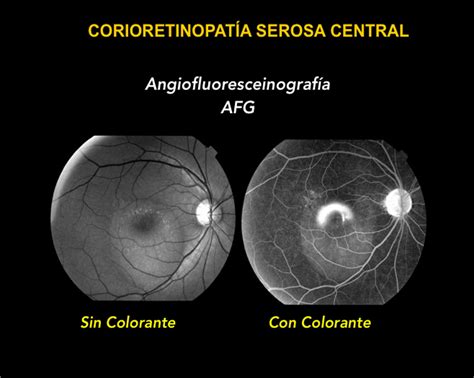 Angiograf A Retinal Somos Retina Y M Cula Consultores