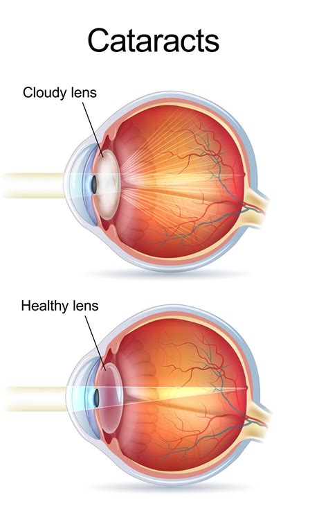 Cataract Surgery - G&G Eye Doctors: Brampton | Cambridge