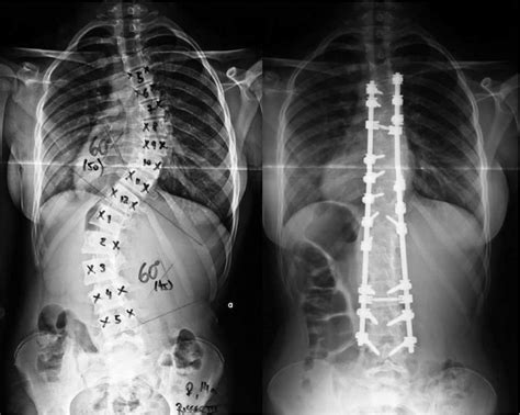 Escoliose Idiopática O que é sintomas diagnóstico e tratamento