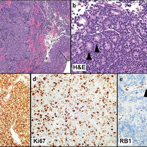 Tumor Histology And Immunohistochemistry A Hematoxylin And Eosin H E