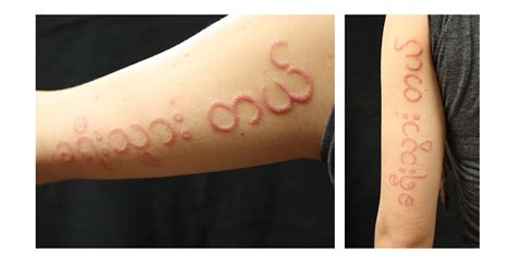 Scarification Branding