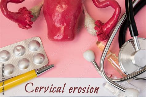 Diagnosis of Cervical Erosion. Medical history of patient with ...