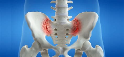 Sacroiliitis Sacroiliac Joint Pain