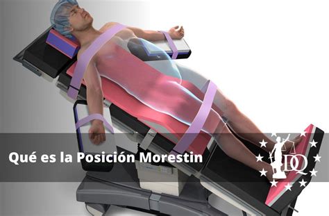 Qu Es La Posici N Morestin La Posici N De Morestin O