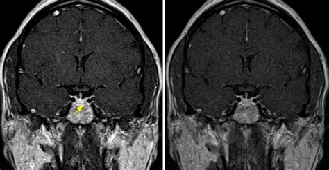 Pituitary Microadenoma | The Neurosurgical Atlas