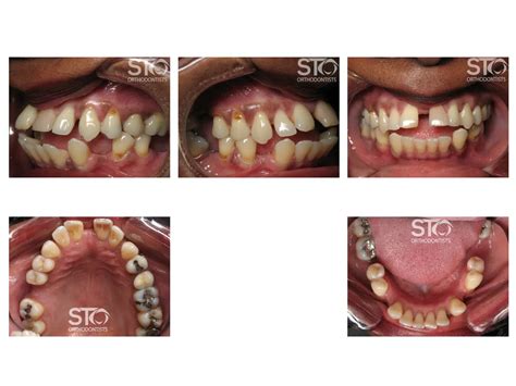 Non Surgical Orthodontics In Scarborough Sto Orthodontists