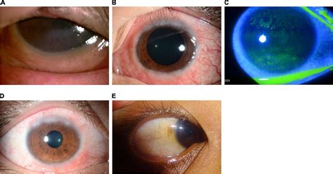 Frontiers Diagnosis Management And Treatment Of Vernal