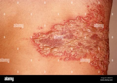 Herpes zoster shingles Fotos und Bildmaterial in hoher Auflösung