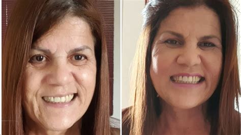 Harmonização Facial aos 60 anos YouTube