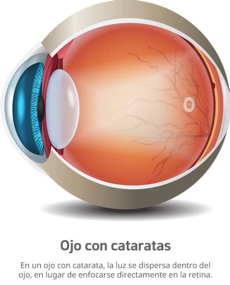 Receta De Lentes Averclaro Cl Nica Oftalmol Gica