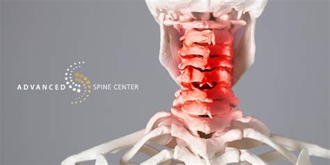 Cervical Fusion Surgery Frisco, TX | Advanced Spine Center