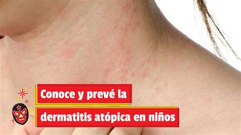 Conoce Y Prevé La Dermatitis Atópica En Niños Youtube