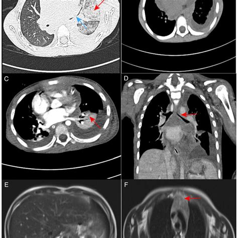 ct  mri images   patient  high resolution ct scan