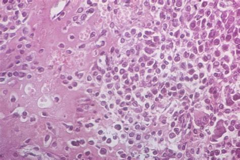 Chondroblastoma Pathology Orthobullets