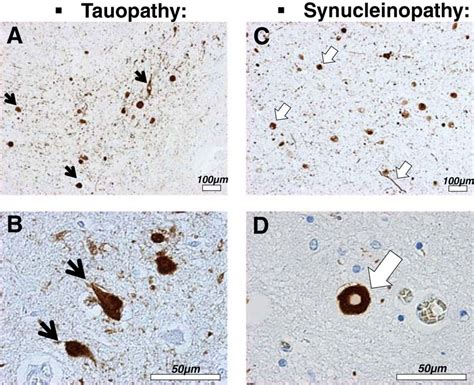 Tau And Synuclein Pathologies A To D Histological Sections From The