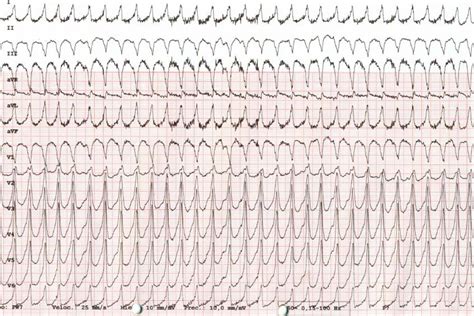 Wide Qrs Complex Tachycardia Circulation