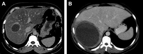 Pyogenic And Amebic Infections Of The Liver Gastroenterology Clinics