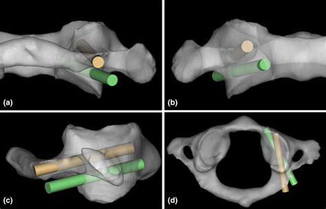 The Imitated Scheme Of Two Screws In C Unilateral Lateral Mass With