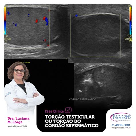 Torção testicular ou torção do cordão espermático Dica do