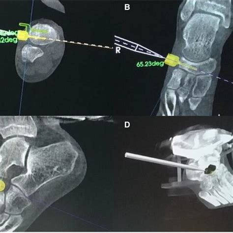 Tinavi Intelligent Orthopedic Robot Navigated During The Operation And