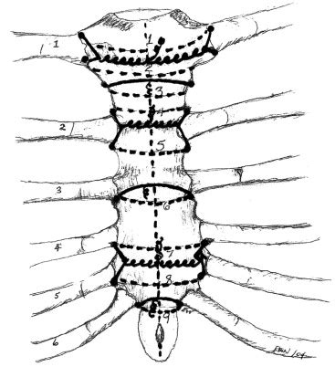 Median Sternotomy Closure A Simple Inexpensive Effective Technique