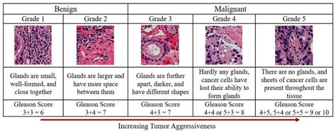 Prostate Cancer Histology