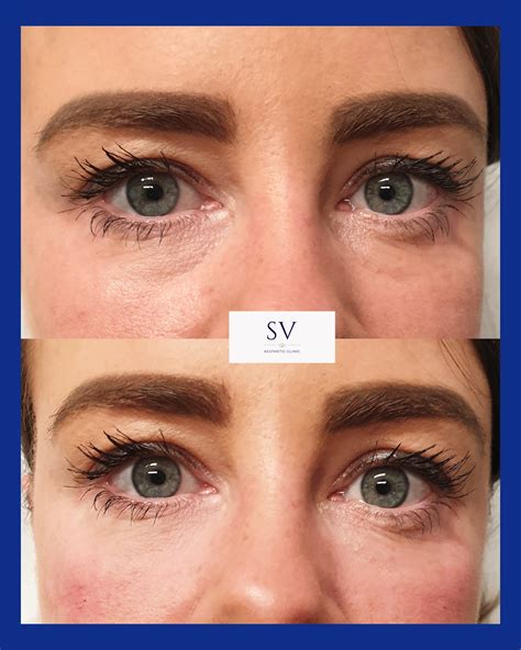 Tear Trough Filler Manchester Sv Aesthetic Clinic