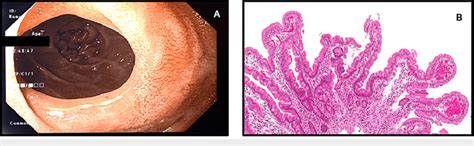 Follow Up Upper Endoscopy And Duodenal Biopsies After Treatment A