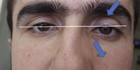 In The Ocular Examination Of A Patient With Left Side Silent Sinus Download Scientific Diagram