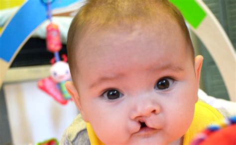 What Is Cleft Lip And Palate Cleftpals Nsw