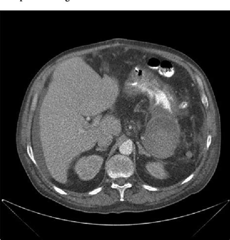 Figure 2 From A Rare Cause Of Acute Upper Gastrointestinal Hemorrhage