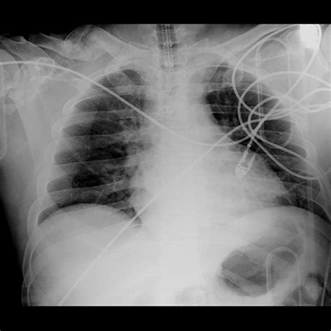 Portable AP Chest Radiograph 3 Of 3