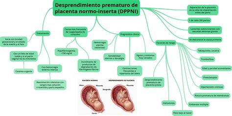 Desprendimiento Prematuro De La Placenta Embarazo Babysitio Hot Sex