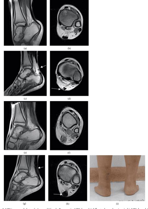 PDF Modified Percutaneous Achilles Tendon Lengthening By Triple