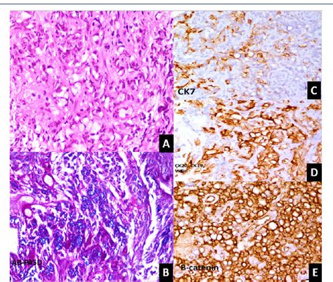 Figure 1 From Metastasis Of Duodenal Adenocarcinoma To The Urinary